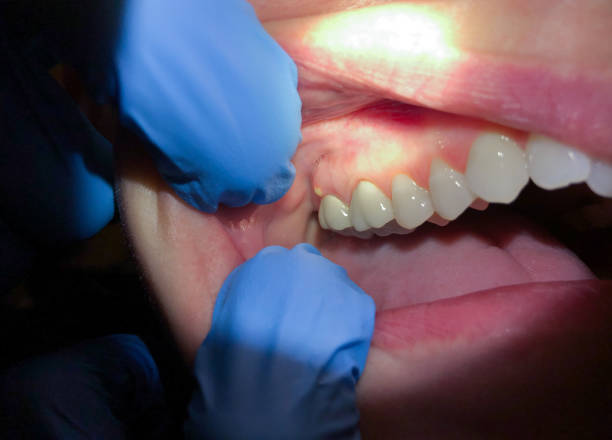 Best Emergency Root Canal Treatment in Renton, WA